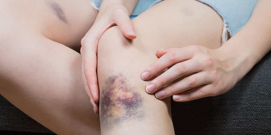 MORETONES SIN CAUSA APARENTE, SANGRADO DE ENCÍAS O HEMORRAGIAS NASALES FRECUENTES, PUEDEN SER SEÑALES DE LEUCEMIA MORETONES SIN CAUSA APARENTE, SANGRADO DE ENCÍAS O HEMORRAGIAS NASALES FRECUENTES, PUEDEN SER SEÑALES DE LEUCEMIA